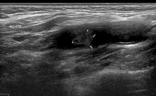 Thrombus of the right carotid artery.