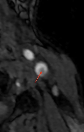 Cross-section showing a bulbar thrombus (MRI).