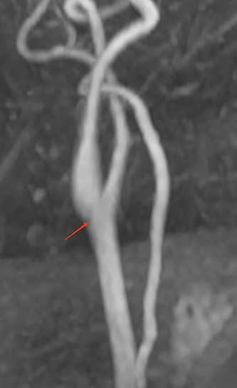 MRI reconstruction image of the left carotid bifurcation showing the carotid diaphragm.