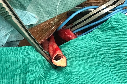 Surgical specimen showing the carotid diaphragm.