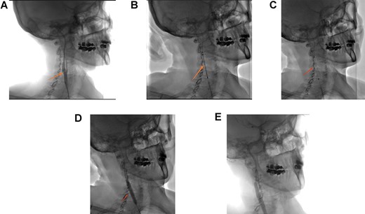 (A) Right carotid angiogram image showing the carotid diaphragm (arrow). (B) Positioning of the carotid stent. (C) Carotid stent release. (D) Stent impaction by angioplasty balloon. (E) Final angiographic control.