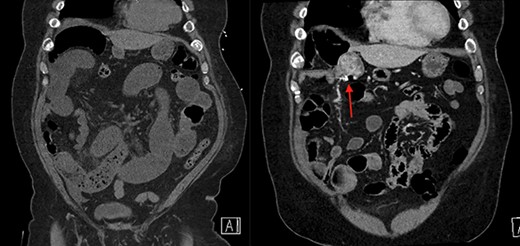 On the left is the initial CT scan non-contrast demonstrating dilated small bowel loops and a transition point in the right lower quadrant. On the right is the CT angiography (CTA), performed a week later, showing a mass and pill cam in the right upper quadrant.