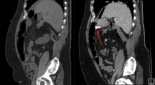 On the left is the initial CT scan non-contrast demonstrating no obvious mass. On the left is the CTA, a week later, showing a mass and pill cam in the right upper quadrant.