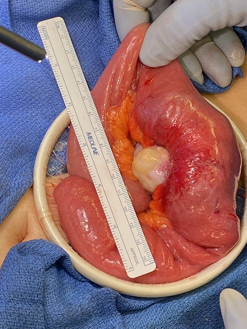Small bowel mass found during the diagnostic laparoscopy.