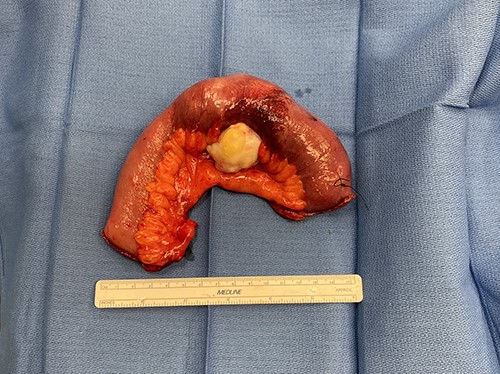 Small bowel mass specimen, post-resection.
