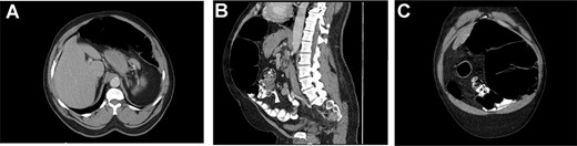 (A) showing distended transverse colon. (B) Sagittal displaying distended splenic flexure, concern for SFV. (C) Coronal view showing dilated splenic flexure, concern for SFV.