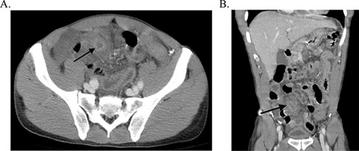 CT scan with black arrow showing thickened appendix.