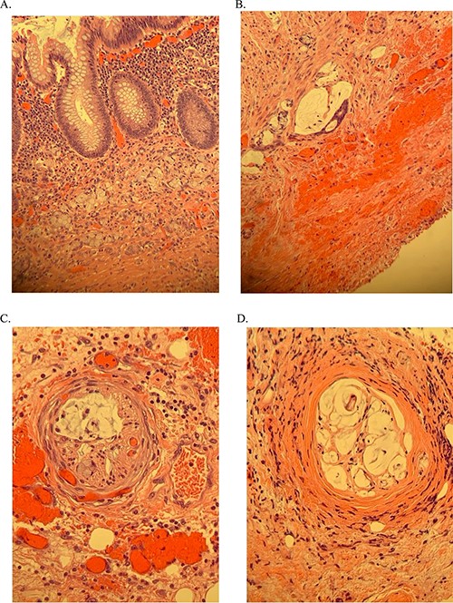 Histology of the appendix following initial laparoscopic appendectomy. (A and B) goblet cells with positive margins. (C) Neuronal invasion. (D) Vascular invasion.