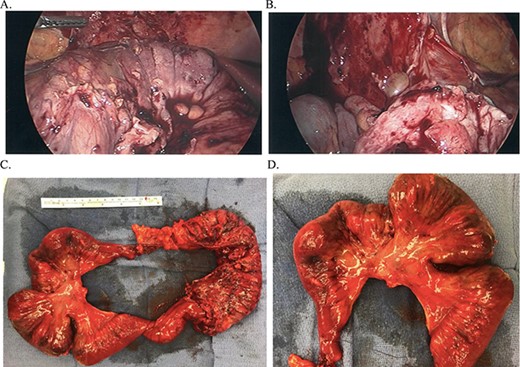 (A and B) Intraoperative findings during laparoscopic right hemicolectomy and (C and D) Right hemicolectomy specimen, mucocele near appendiceal base.