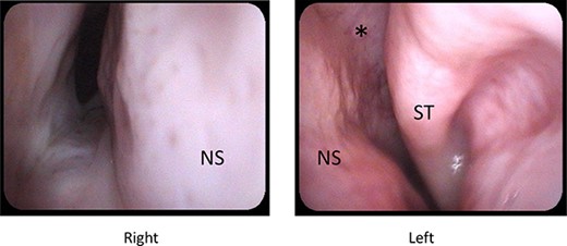 Preoperative nasal endoscopy; right nasal cavity is narrowed due to deviated nasal septum and fused maxillary and palatal bone; middle and inferior turbinates were deficient; superior turbinate and olfactory cleft were noted; abbreviations: ST, superior turbinate; NS, nasal septum; *, olfactory cleft.