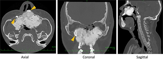 Preoperative computed tomography (CT) shows severe bone formation with inversed teeth (arrow heads); space between nose and pharynx was narrow.