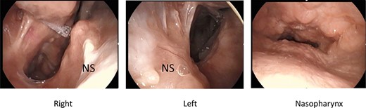 Post-operative nasal endoscopy; new nasal cavity has been created; posterior nasal septum and bilateral inferior and middle turbinates were defective; nasopharyngeal closure was incomplete because of submucosal cleft palate, but no exacerbation of regurgitation was observed after the surgery.