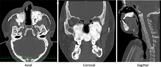Post-operative CT midline bone has been drilled out, and space for nasal airflow has been widened.