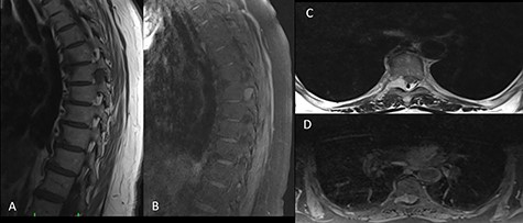 On preoperative MRI, the mass was (A) hypointense on T1-weighted sagittal images, (B) hyperintense on contrast-enhanced T2-weighted sagittal images, (C) hyperintense on T2-weighted axial images and (D) isointense on T1-weighted axial images.