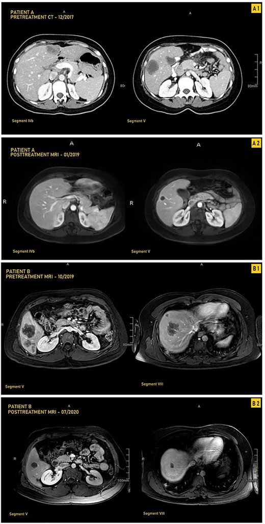 CT and MRI images our two patients before and after treatment with pembrolizumab; (A1) Pretreatment MRI of our first patient in September 2017 showing most prominent lesions, located in Segments IVb and V, on axial enhanced CT after contrast administration; (A2) Posttreatment axial enhanced T1-weighted MRI of our first patient in January 2019 showing most prominent lesions located in Segments IVb and V; the lesion in Segment V is smaller, measuring 1.4 cm, and is completely necrotic; (B1) Pretreatment axial enhanced T1-weighted sequence MRI performed on 3Tesla field strength following gadolinium contrast administration in our first patient in October 2019 showing most prominent lesions, located in Segments V and VIII; the largest metastatic lesion is a 4.8-cm heterogeneously enhancing metastatic lesion in Segment VIII; (B2) Posttreatment axial enhanced T1-weighted sequence MRI performed on 3Tesla field strength following gadolinium contrast administration in the hepatobiliary phase in our second patient in July 2020, showing most prominent lesions located in Segments V and VIII; the largest lesion in Segment VIII decreases in size to 1.5 cm following treatment and is completely necrotic.