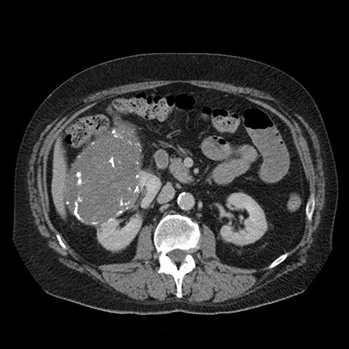 Abdominal computed tomography showing a large tumour of the right kidney and obstruction of the small intestine at the level of the proximal jejunum.