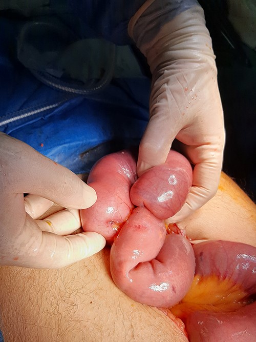 On laparotomy, jejuno-jejunal intussusception was found approximately 50 cm distal to the ligament of Treitz.