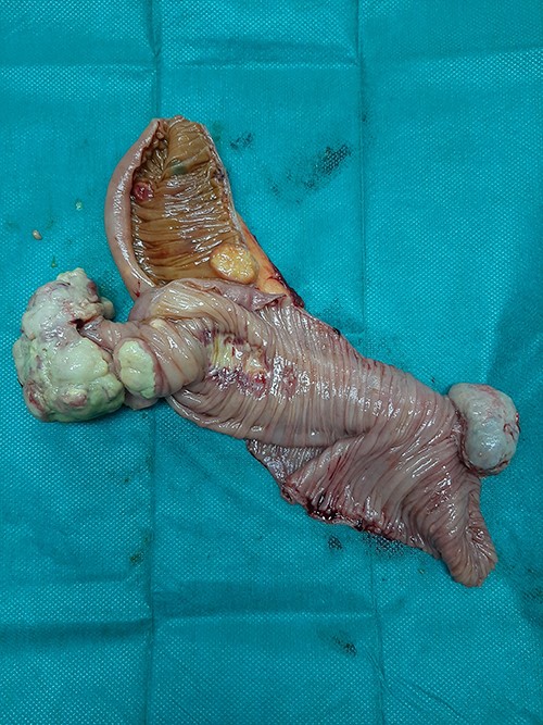 Multiple endoluminal neoplastic lesions in the resected specimen.