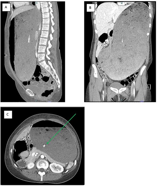 a CT image of the gross gastric distension extending into the pelvis secondary to a binge episode in the (A) sagittal, (B) coronal and (C) axial slices; the nasogastric tube (green arrow) is appropriately placed within the gastric lumen