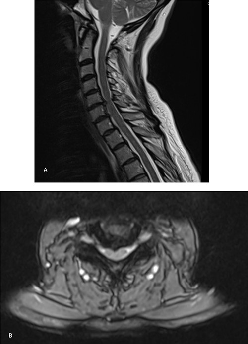 MRI showing bilateral C6 nerve root compression and left C7 nerve compression, C5–C8 disc herniation indenting the ventral aspect of the cord without typical signs of compression myelopathy or significant intramedullary signal abnormality. A. Sagittal view. B. Axial view.
