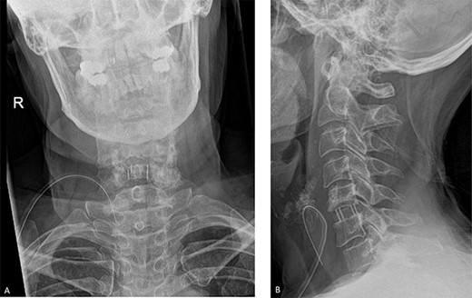 Post-operative radiographs. A. Anteroposterior view. B. Lateral view. The C5/C6 disc was identified using X-ray guidance and the vertebral bodies were distracted using Caspar pins. The endplates were prepared with a curette and the discectomy was performed. The posterior osteophytes were thinned with a matchstick drill and the posterior longitudinal ligament and posterior osteophytes were removed with Kerrison rongeurs.
