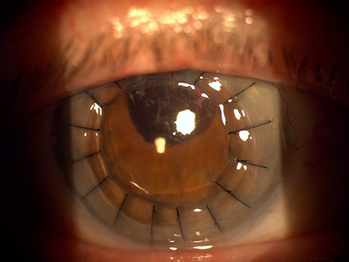 Slit-lamp photograph of the right eye the day after penetrating keratoplasty.