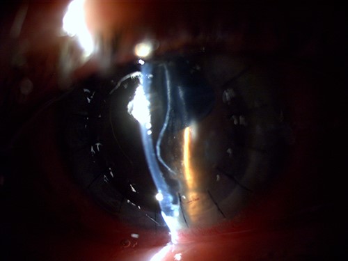 Slit-lamp visualization of a wavy retained Descemet membrane with supernumerary anterior chamber formation in the right eye on the day following penetrating keratoplasty.