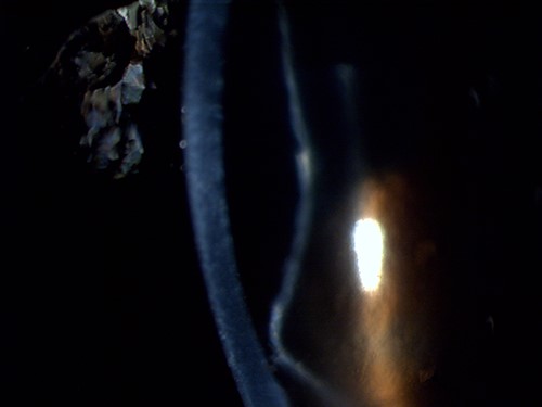 Slit-lamp photograph zoomed in on the cross-section of the cornea and the retained Descemet membrane in the right eye.