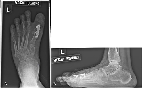 AP (A) and Lateral (B) X-ray the left foot. Metal implants seen over dorsal MTPJ of the 1st toe after corrective hallux valgus surgery.