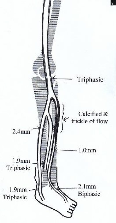 Illustrated diagram of left lower limb arterial duplex scan showing 70–80% occlusive disease at the proximal ATA.