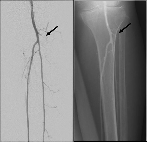 Left lower limb diagnostic angiogram showing occlusion of the ATA with poor flow (arrow).