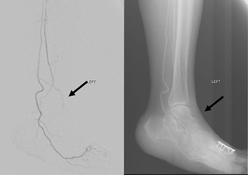 Angiogram of left distal leg and foot showing poor flow of the distal ATA and dorsalis pedis artery (arrow).