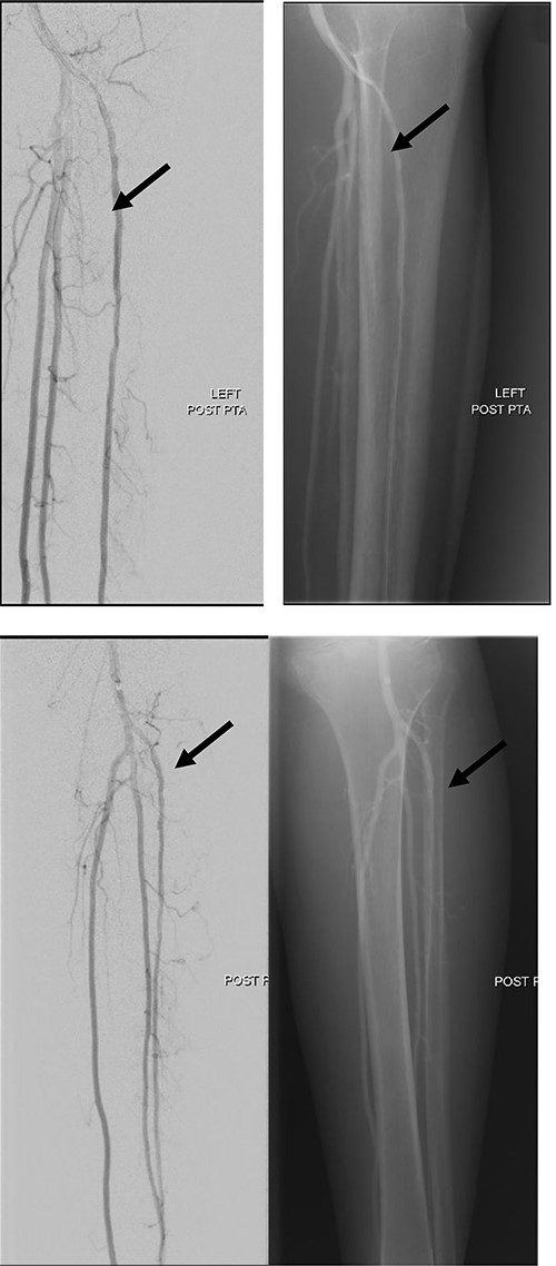 Good arterial flow of the ATA (arrow) after successful angioplasty and stenting.