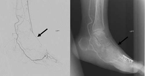 Arterial flow noted at distal ATA and dorsalis pedis artery (arrow) after successful angioplasty and stenting.
