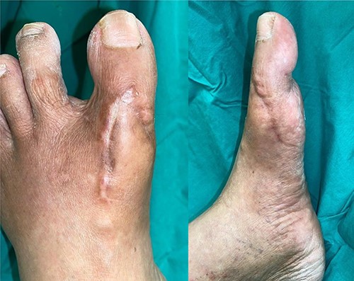 Three-month post-operative, flap is fully healed and left foot remains well vascularized with palpable dorsalis pedis pulse.