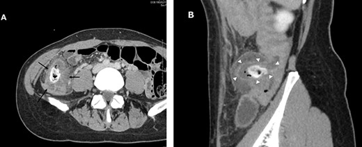 Abdominal and pelvic CT with intravenous contrast at the time of consultation. Axial image (A) demonstrated cecal colon diverticulum (black arrows) and sagittal image (B) demonstrated thickening and mural edema of the diverticulum (white arrowheads), indicating inflammation.
