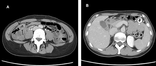 Abdominal and pelvic CT on hospitalization Day 3. Axial images (A and B) showing improved cecal colon diverticulitis (black arrows); however, fecaliths migrated to the transverse colon (white arrowheads).
