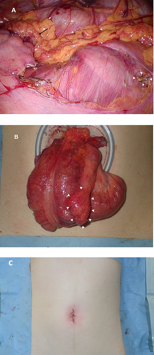 Intraoperative images. Image (A) demonstrating the anastomotic site (black arrows) and ileocolic artery and veinous dissection (white arrowheads). Image (B) showing the ileocecal region raised outside the body and a diverticulum (white arrowheads). Image (C) shows after closure.