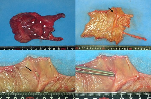 Macroscopic findings of the surgical specimen showing a diverticulum with an ulcer in the cecal colon (white arrowheads) and no fecalith (black arrows).