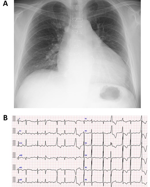 Preoperative chest X-ray (A) and electrocardiogram (B).