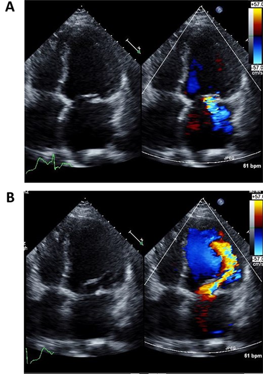 Preoperative echocardiography of left ventricle in systolic (A) and diastolic (B) phases.
