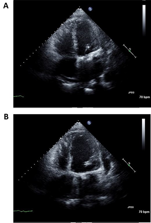 Postoperative echocardiography of left ventricle in systolic (A) and diastolic (B) phases.