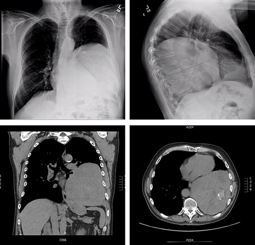 Representation of solitary fibrous tumour in 2019 showing 18.3 × 17.0 × 13.8 cm left-sided pleural-based tumour.