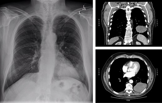 Initial presentation of solitary fibrous tumour in 2013 showing 9.3 × 6.1 cm left-sided pleural-based tumour.