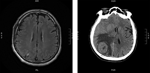 Brain imaging; solitary right parietal brain metastasis measuring 6 mm August 2019 (left) and 4.5 months later measuring 4.1 cm (right).
