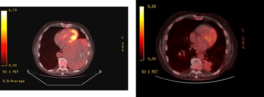 PET scans; large left-sided pleural-based tumour exhibits mild FDG uptake, with the SUV max of 2.9 (left); recurrent disease at the pulmonary resection margin along with contralateral pulmonary metastases demonstrated (right).