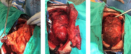 Gross appearance of solitary fibrous tumour during en bloc resection via left thoracotomy showing thickened pleural and tumour in situ.