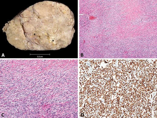 A, macroscopic appearance of solitary fibrous tumour, with foci of necrosis (*). B–D, histologic appearance of solitary fibrous tumour, with variably cellular bland spindled cells in vague fascicles and with diffuse STAT6 immunoreactivity (B, H&E stain, original magnification x40; C, H&E stain, original magnification x100; D, STAT6 immunohistochemical study, original magnification x100).