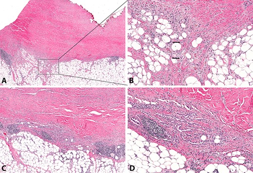 Atypical mesothelial proliferation composed of single cells and small cell clusters (A&B) and irregular tubules (C&D), with invasion of subpleural adipose tissue (arrows, B) (A, H&E stain, original magnification x20; B, H&E stain, original magnification x100; C, H&E stain, original magnification x40; D, H&E stain, original magnification x100).