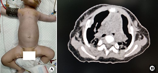 (A) Thorax appearance before operation, and (B) CT scan image of thorax before operation.
